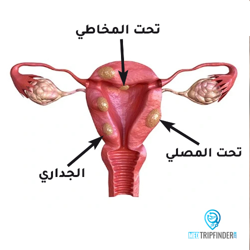 شكل الورم الليفي في الرحم